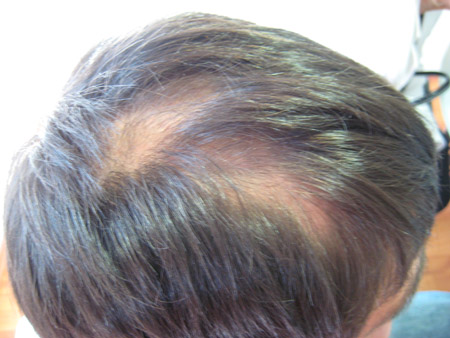 tratamiento contra la alopecia