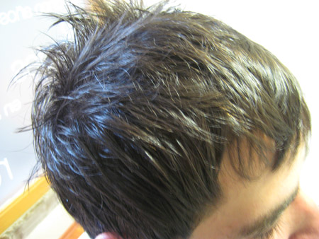 tratamiento alopecia