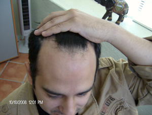 alopecia_areata