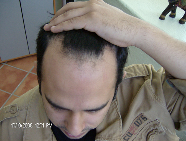 alopecia_areata