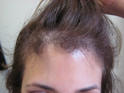 alopecia