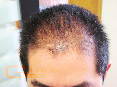 alopeciaareata