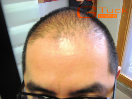 alopecia