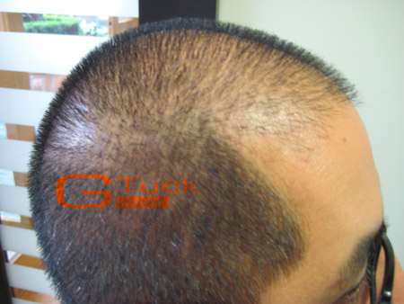 tratamiento alopecia