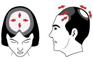 tipos de alopecia